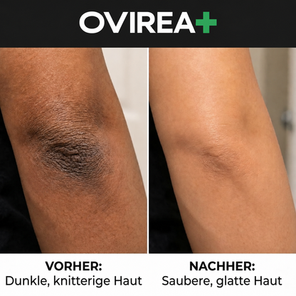 Kojisäure-Kurkuma-Sprühmittel gegen dunkle Hautflecken